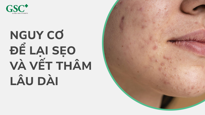 Nguy cơ để lại sẹo và vết thâm lâu dài