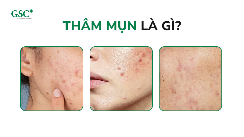 Thâm mụn là gì