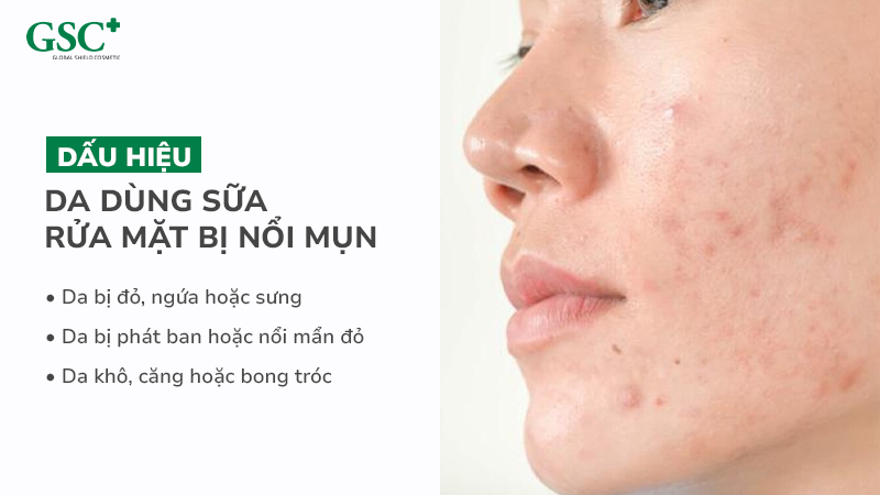 Dấu hiệu da dùng sữa rửa mặt bị nổi mụn